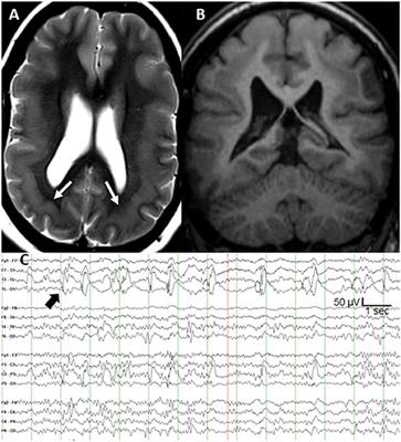 Case Report: PAFAH1B1 Mutation and Posterior Band Heterotopia With Focal Temporal Lobe Epilepsy Treated by Responsive Neurostimulation